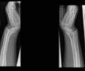 Bilateral madelung deformity (Radiopaedia 47781-52505 Lateral 1).png