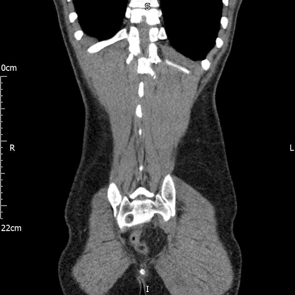 File:Bilateral medullary nephrocalcinosis with ureteric calculi (Radiopaedia 71269-81569 Coronal non-contrast 65).jpg