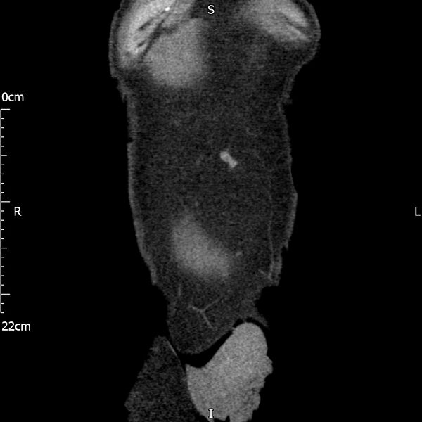 File:Bilateral medullary nephrocalcinosis with ureteric calculi (Radiopaedia 71269-81569 Coronal non-contrast 7).jpg