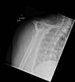 Bilateral shoulder injuries on chest x-ray (Radiopaedia 50809-56297 Lateral 1).jpg