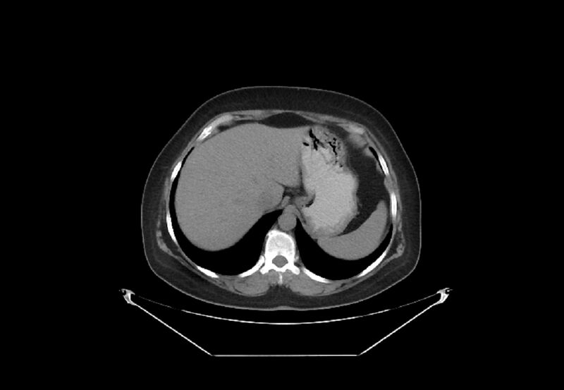 File:Bilateral urolithiasis with incidentally detected splenic artery aneurysm and left inferior vena cava (Radiopaedia 44467-48123 Axial non-contrast 4).jpg