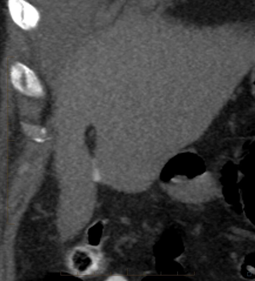Bile leak from accessory duct(s) of Luschka post cholecystectomy (Radiopaedia 40736-43389 B 16).jpg