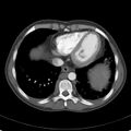 Biliary necrosis - liver transplant (Radiopaedia 21876-21846 A 5).jpg