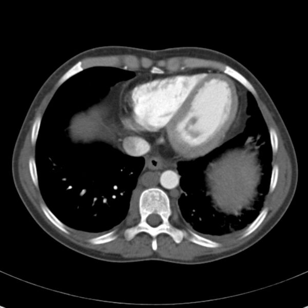 File:Biliary necrosis - liver transplant (Radiopaedia 21876-21846 A 5).jpg