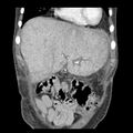 Biliary necrosis - liver transplant (Radiopaedia 21876-21846 C 8).jpg