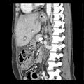 Biliary necrosis - liver transplant (Radiopaedia 21876-21846 D 2).jpg