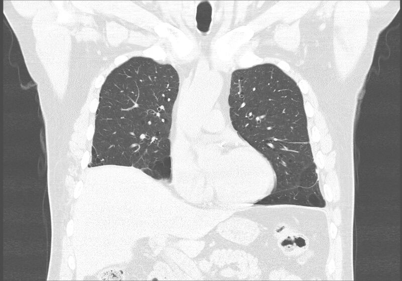 File:Birt-Hogg-Dubé syndrome (Radiopaedia 52578-58491 Coronal lung window 19).jpg