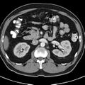 Bosniak cyst - type IV (Radiopaedia 23525-23627 renal cortical phase 20).jpg