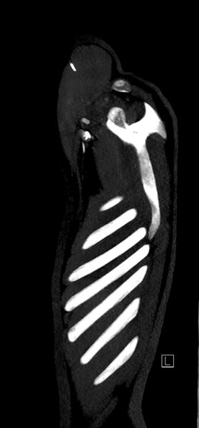 File:Brachiocephalic trunk pseudoaneurysm (Radiopaedia 70978-81191 C 6).jpg