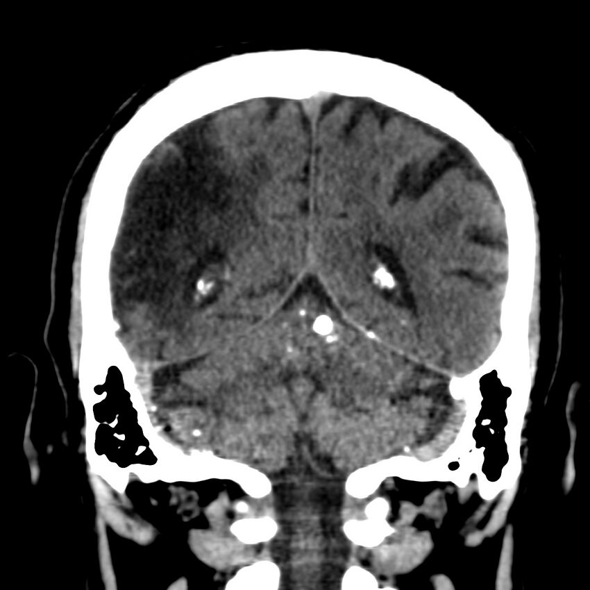 Brain Pantopaque remnants (Radiopaedia 78403-91048 Coronal non-contrast 50).jpg