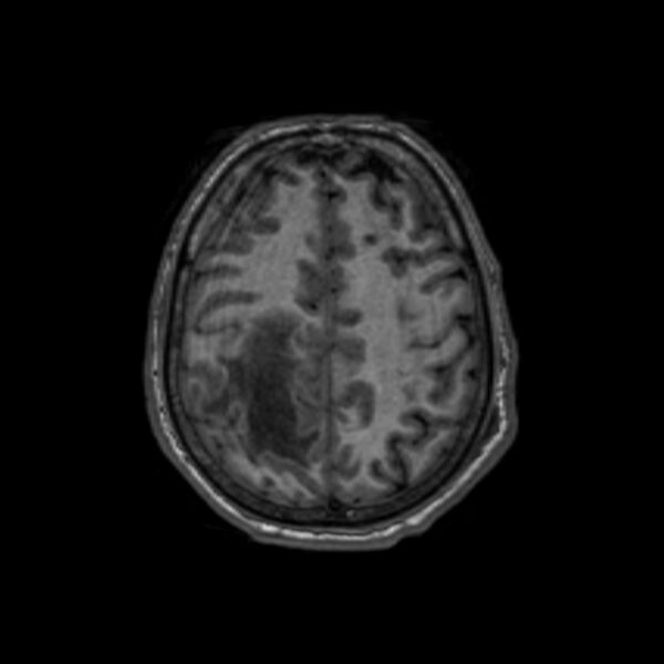 File:Brain abscess complicated by intraventricular rupture and ventriculitis (Radiopaedia 82434-96577 Axial T1 54).jpg