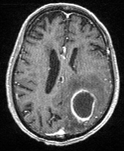 File:Brain abscess with dual rim sign (Radiopaedia 87566-103938 Axial T1 C+ 106).jpg