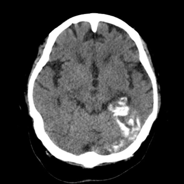File:Brain cortical laminar necrosis (Radiopaedia 25822-25971 Axial non-contrast 17).jpg