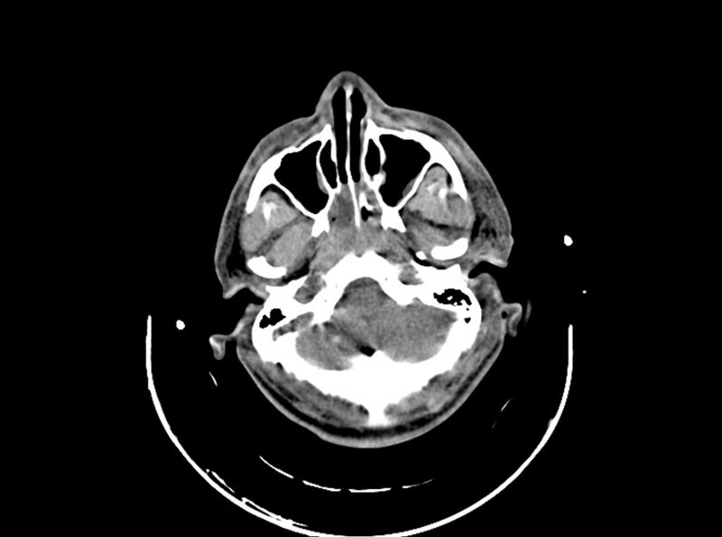 File:Brain injury by firearm projectile (Radiopaedia 82068-96087 B 51).jpg