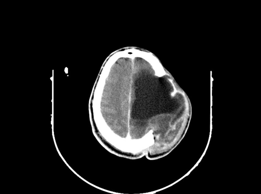 Brain injury by firearm projectile (Radiopaedia 82068-96088 B 173).jpg