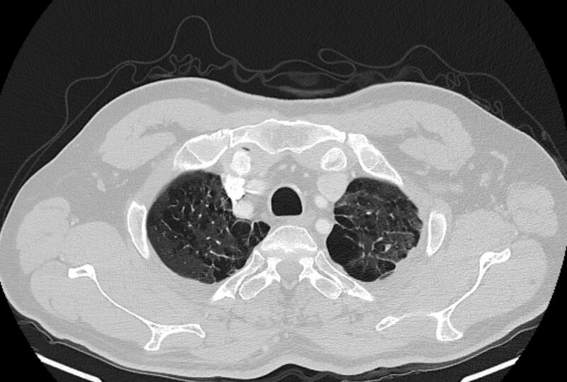 File:Brain metastases - lung cancer primary (Radiopaedia 75060-86116 Axial lung window 6).jpg