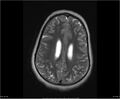Brainstem glioma (Radiopaedia 21819-21775 Axial T2 28).jpg