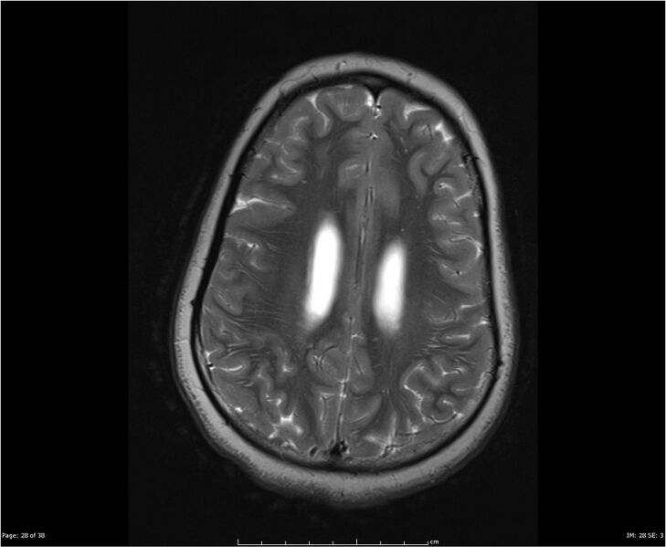 File:Brainstem glioma (Radiopaedia 21819-21775 Axial T2 28).jpg