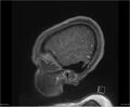 Brainstem glioma (Radiopaedia 21819-21775 D 39).jpg