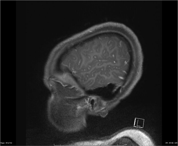File:Brainstem glioma (Radiopaedia 21819-21775 D 39).jpg
