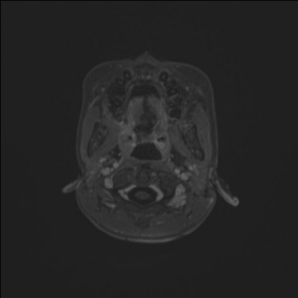 File:Brainstem glioma (Radiopaedia 70548-80674 Axial T1 C+ 9).jpg