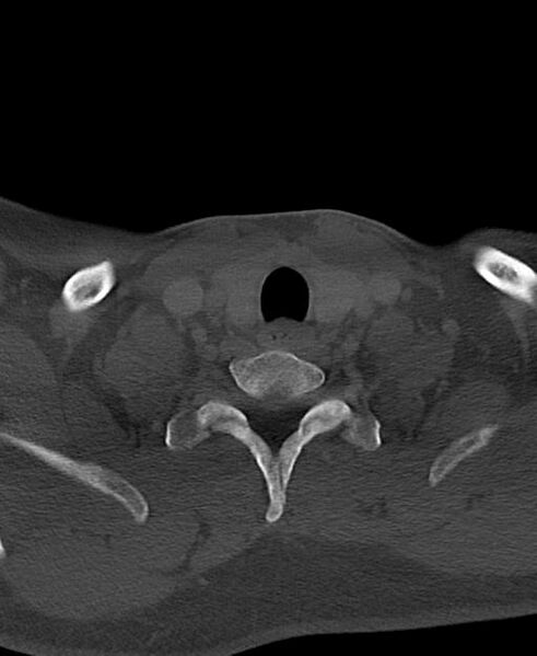 File:Branchial cleft cyst (Radiopaedia 31167-31875 Axial bone window 62).jpg