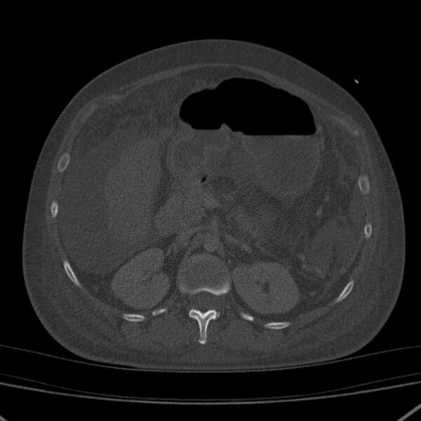 File:Breast cancer metastases - hepatic and skeletal (Radiopaedia 34201-35461 Axial bone window 51).jpg