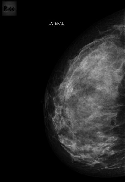 File:Breast carcinoma (Radiopaedia 33083-34110 CC 1).jpg
