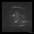 Broad ligament fibroid (Radiopaedia 49135-54241 Axial DWI 21).jpg