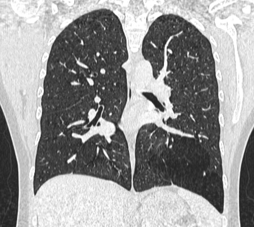Bronchial atresia (Radiopaedia 50007-55297 Coronal lung window 64).jpg