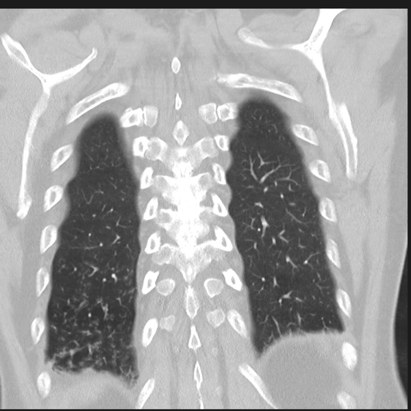 File:Bronchiectasis (Radiopaedia 39385-41666 Coronal lung window 30).png