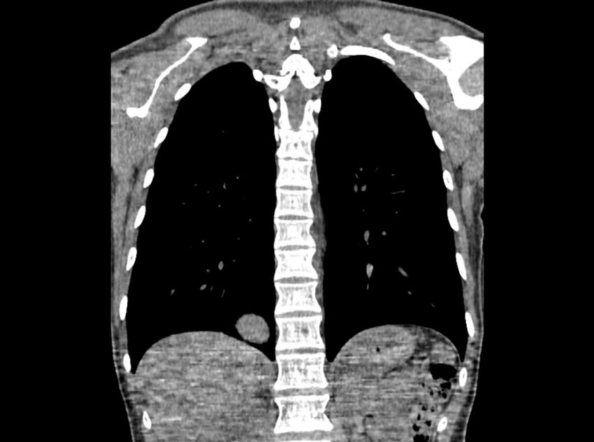 Bronchogenic cyst (Radiopaedia 80273-93615 D 81).jpg