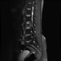 Burst fracture - lumbar spine (Radiopaedia 72877-83541 Sagittal STIR 3).jpg
