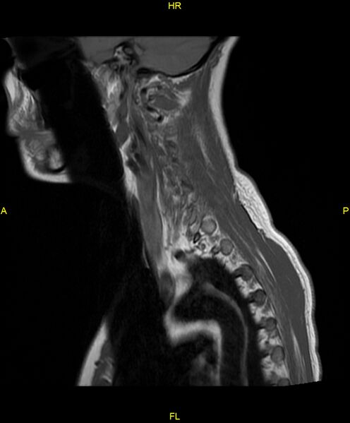 File:C5 nerve sheath tumor (Radiopaedia 85777-101596 Sagittal T1 16).jpg