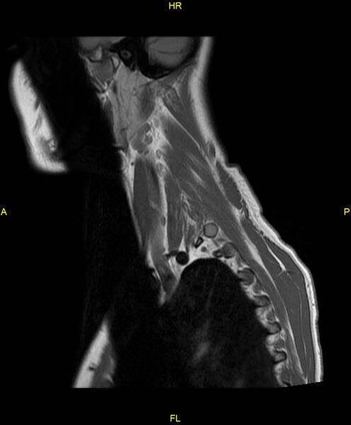 File:C5 nerve sheath tumor (Radiopaedia 85777-101596 Sagittal T1 3).jpg
