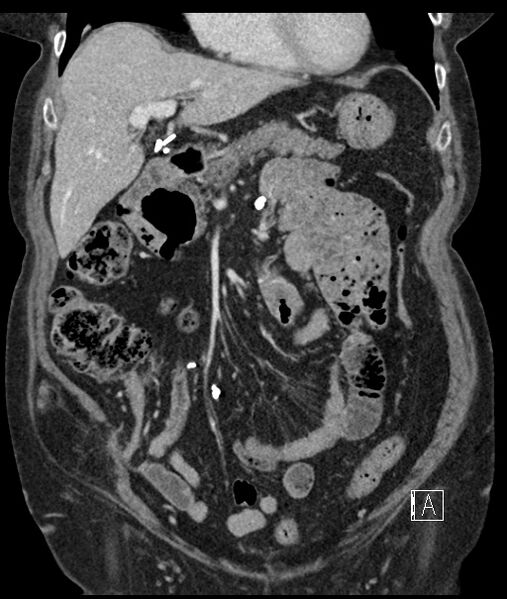 File:Calcified adrenal glands and Spigelian hernia (Radiopaedia 49741-54988 B 39).jpg