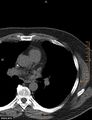 Calcified cardiac fibroma (Radiopaedia 39267-41519 Axial non-contrast 4).jpg