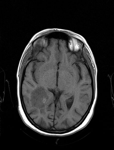 File:Calcified cerebral hydatid cyst (Radiopaedia 65603-74699 Axial T1 11).jpg