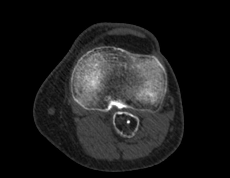 File:Calcified hematoma - popliteal fossa (Radiopaedia 63938-72763 Axial bone window 39).jpg