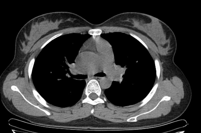 File:Cannonball metastases - uterine choriocarcinoma (Radiopaedia 70137-80173 Axial non-contrast 42).jpg