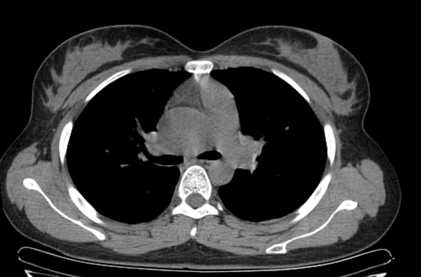 Cannonball metastases - uterine choriocarcinoma (Radiopaedia 70137-80173 Axial non-contrast 42).jpg