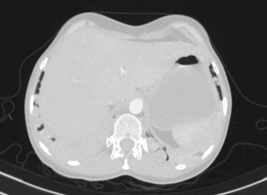 Cannonball metastases from breast cancer (Radiopaedia 91024-108569 Axial lung window 96).jpg