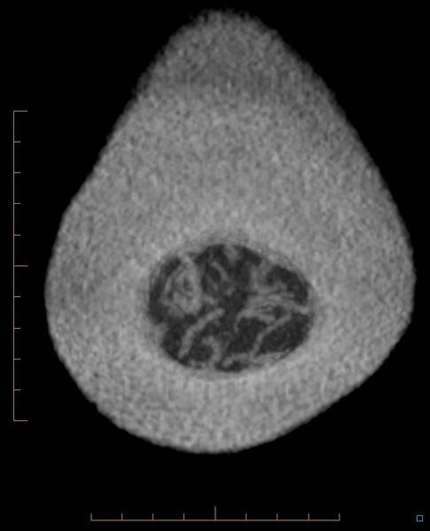 File:Caput medusa (Radiopaedia 50425-82886 thick MIP coronal 1).jpg