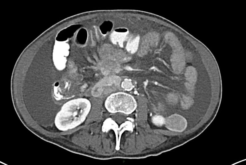 File:Carcinoid mesenteric tumor complicated by chylous ascites (Radiopaedia 76312-87953 A 38).jpg