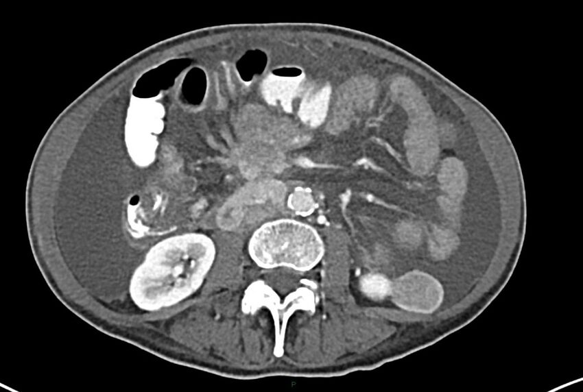 Carcinoid mesenteric tumor complicated by chylous ascites (Radiopaedia 76312-87953 A 38).jpg