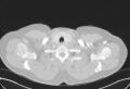 Cardiac sarcoidosis (Radiopaedia 74548-85534 Axial lung window 3).jpg