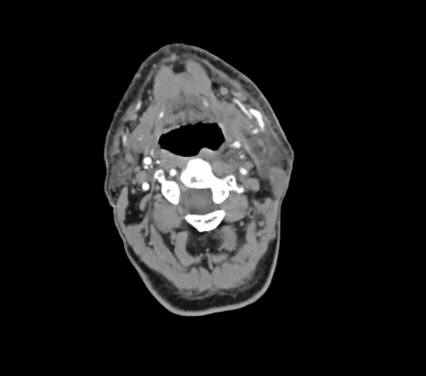 Carotid artery pseudoaneurysm (Radiopaedia 84030-99259 C 31).jpg