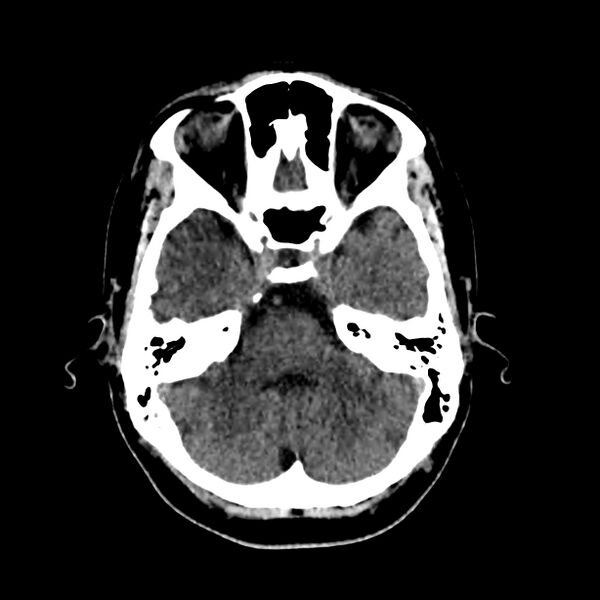 File:Central nervous system Langerhans cell histiocytosis (Radiopaedia 65728-74878 Axial non-contrast 16).jpg