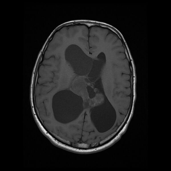 File:Central neurocytoma (Radiopaedia 67618-77021 Axial T1 15).jpg