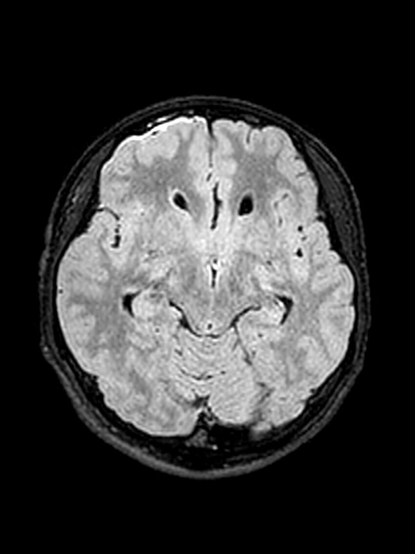 Central neurocytoma (Radiopaedia 79320-92381 Axial FLAIR 101).jpg